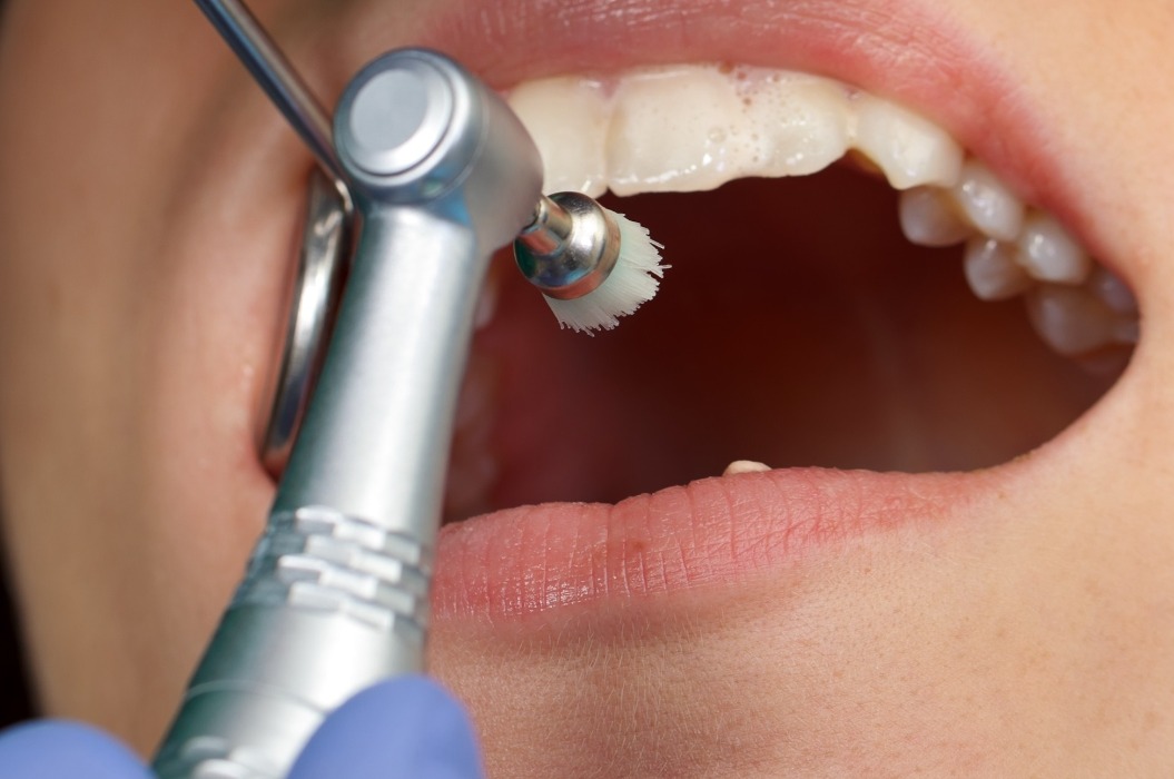 Professionelle Zahnreinigung